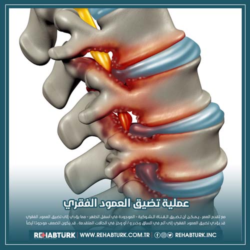 عملية تضيق العمود الفقري في تركيا
