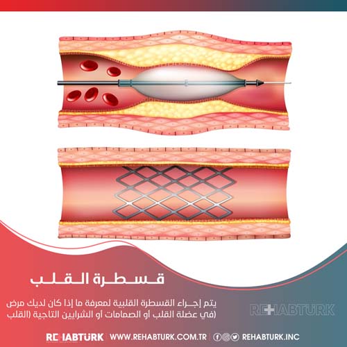 إجراء قسطرة القلب في تركيا
