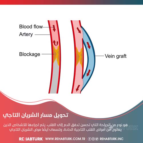 عملية تحويل مسار الشريان التاجي في تركيا