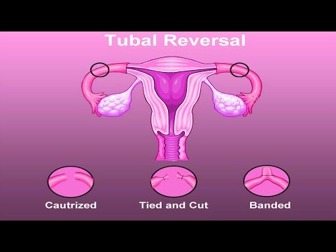 عملية عكس ربط البوق بالمنظار في تركيا